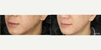 Sylfirm X before and after photo
