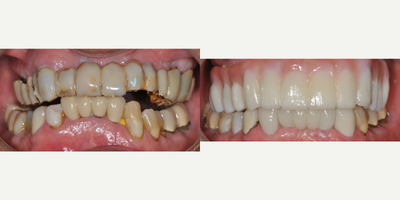 All-on-4 Dental Implants before and after photo