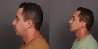 Chin Implant before and after photo