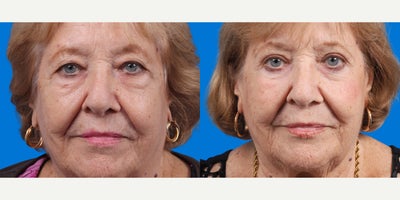 Eyelid Surgery before and after photo