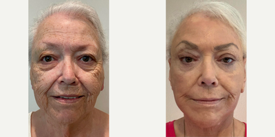Facelift before and after photo
