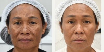 PicoWay before and after photo