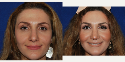Revision Rhinoplasty before and after photo