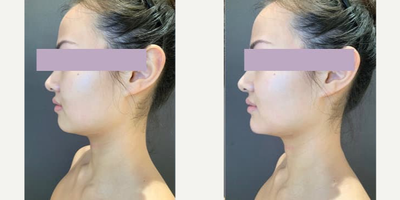 Voluma before and after photo