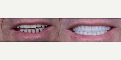 All-on-4 Dental Implants before and after photo