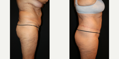 Body Lift before and after photo