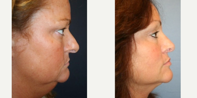 Neck Lift before and after photo