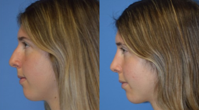 Rhinoplasty before and after photo