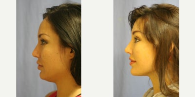 Rhinoplasty before and after photo