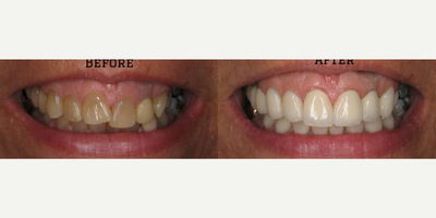 Smile Makeover before and after photo