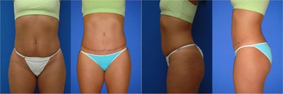 Tummy Tuck before and after photo