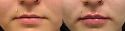 Lip Fillers before and after photo