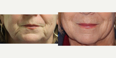 Dermal Fillers before and after photo
