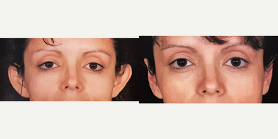 Ear Surgery before and after photo