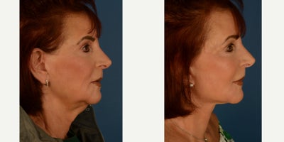 Lower Facelift before and after photo