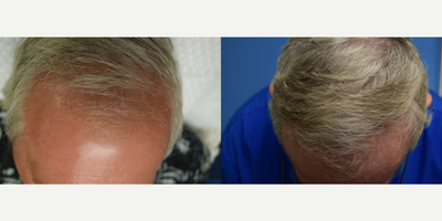 PRP for Hair Loss before and after photo
