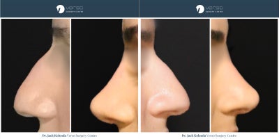 Rhinoplasty before and after photo