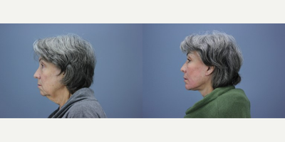 Brow Lift before and after photo