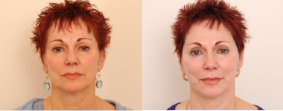 Facelift before and after photo