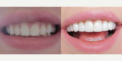 Porcelain Veneers before and after photo
