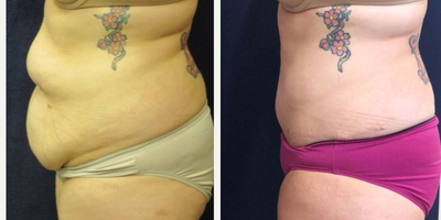 Tummy Tuck before and after photo