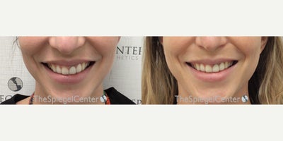 Botox for Gummy Smile before and after photo