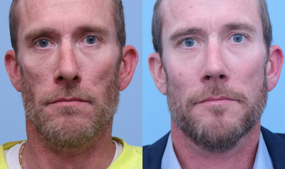 Cheek Augmentation before and after photo