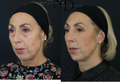 Eyelid Surgery before and after photo