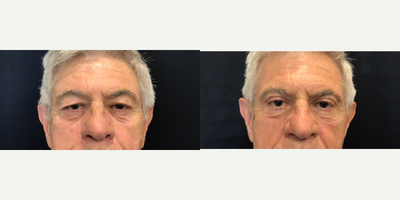 Eyelid Surgery before and after photo
