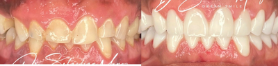 Dental Implants before and after photo