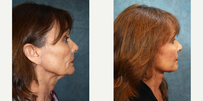 Facial Fat Transfer before and after photo
