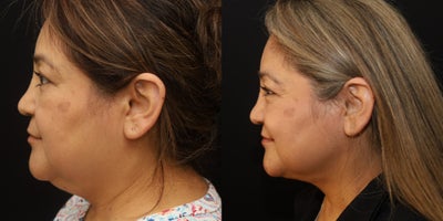 Liposuction before and after photo