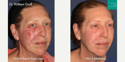 Vbeam before and after photo