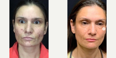 Chemical Peel before and after photo