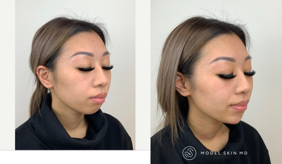 Chin Filler before and after photo