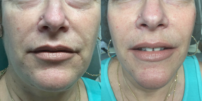Dermal Fillers before and after photo
