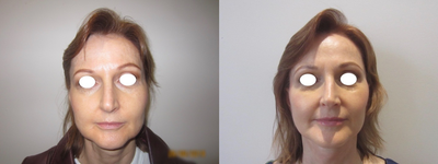 Facelift before and after photo