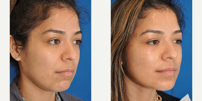 Facelift before and after photo