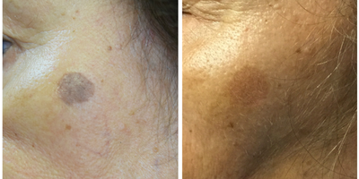 IPL before and after photo