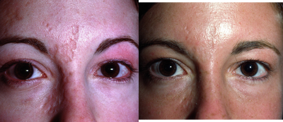 Scar Removal before and after photo