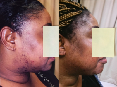 Chemical Peel before and after photo