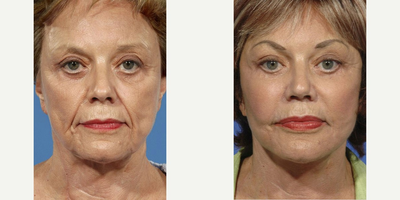 Facelift Revision before and after photo