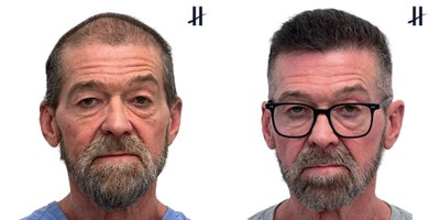 FUE Hair Transplant before and after photo