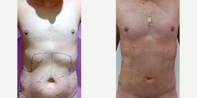 Laser Liposuction before and after photo
