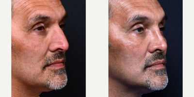 Rhinoplasty before and after photo