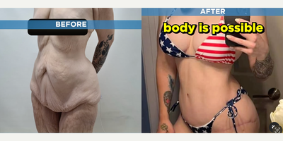 Tummy Tuck before and after photo