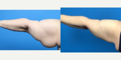 Arm Lift before and after photo