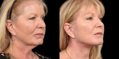 Eyelid Surgery before and after photo