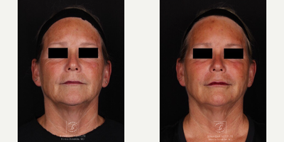 IPL before and after photo