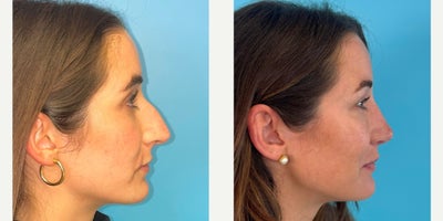Revision Rhinoplasty before and after photo